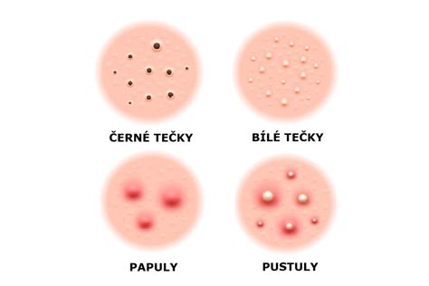 infografika typov akné (čierne bodky, biele bodky, papuly, pustuly, noduly, cysty)