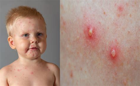 Detailný záber na rôzne formy kožných vyrážok (makuly, papuly a pľuzgiere) pre lepšiu diagnostiku