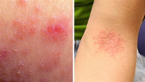 Schéma porovnávajúca dráždivý a alergický kontaktný ekzém