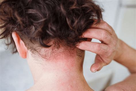 Schéma lokalizácie seboroickej dermatitídy u dojčiat: pokožka hlavy, obočie, oblasť za ušami a kožné záhyby.