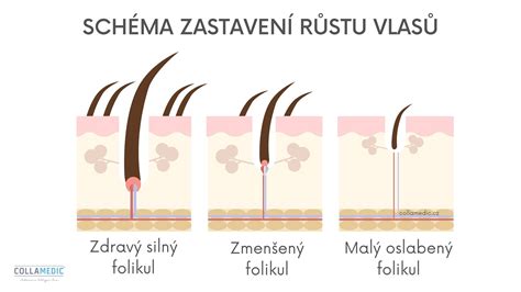 Detailná schéma štruktúry pokožky zobrazujúca zapálený vlasový folikul a hlboko uložené cystické ložisko podkožného akné