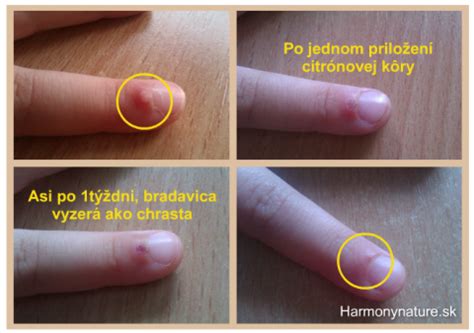 Fotografia detailu bradavice na prste.