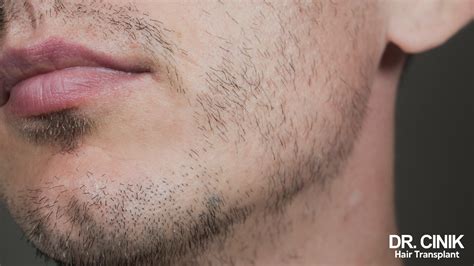 Detail fúzy s okrúhlym ložiskom alopecia barbae