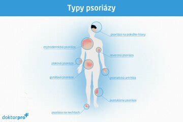 Infografika: Ilustrácia typických kožných prejavov psoriázy na rôznych častiach tela