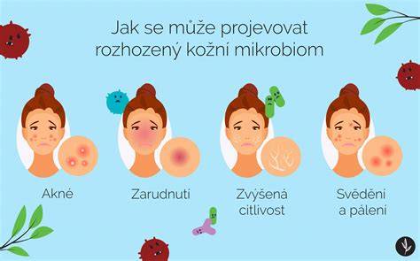 infografika: štruktúra atopickej pokožky a narušená bariéra