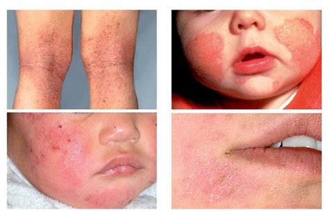Tematické foto: Rôzne kožné ochorenia (dermatitída, psoriáza, ekzém)