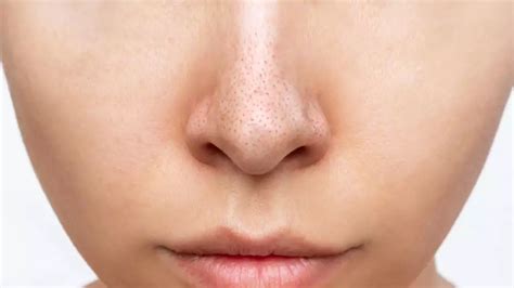 Tematické foto: closeup tváre s viditeľnými čiernymi bodkami na nose a brade
