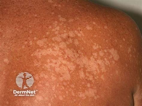 Porovnávacia tabuľka: rozdiely medzi vitiligom, pityriasis versicolor a albinizmom.