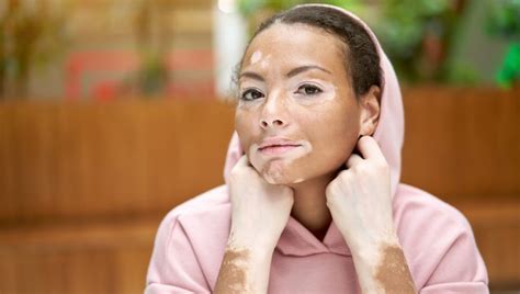 Ilustračná fotografia bielych škvŕn na koži spôsobených vitiligom.