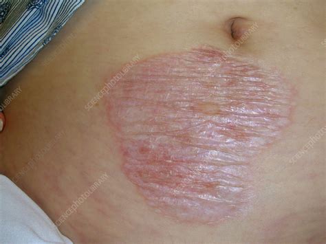 Ilustrácia postihnutej oblasti pri lichen sclerosus penisu