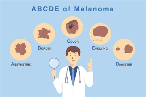 Schematické znázornenie ABCDE pravidla pre rozpoznávanie melanómu