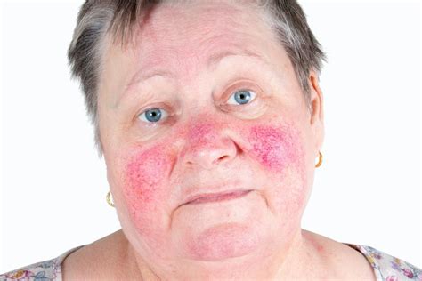 Ilustrácia rôznych typov dermatitídy na tvári