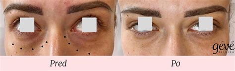 Aplikácia emoliencia na tvár