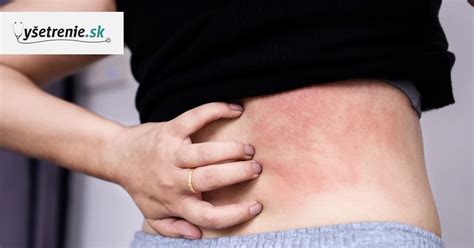 Ilustrácia znázorňujúca začarovaný kruh svrbenia a škrabania pri atopickom ekzéme.