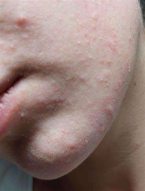 Detailné zobrazenie seborey na tvári, zdôrazňujúce začervenanie a šupinatenie