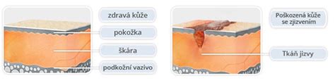 vizualizácia hypertrofickej jazvy na koži