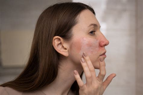 Ilustrácia znázorňujúca žihľavku na koži