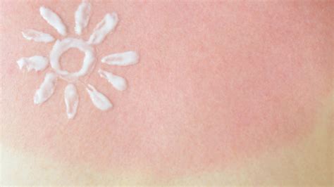 Ilustračná fotografia pokožky po opaľovaní