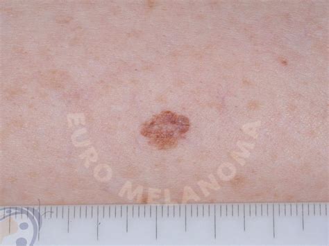 Ilustrácia znázorňujúca nepravidelné okraje a nerovnomernú pigmentáciu dysplastického névusu.