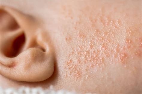 Ilustrácia porovnávajúca dojčenské akné, ekzém a potničky