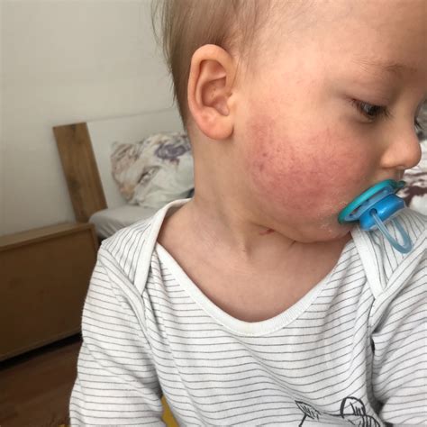 Ilustračné foto tváre dieťaťa s miernym začervenaním na lícach