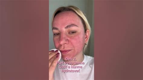 Ilustračná fotografia zobrazujúca proces laserového resurfacingu tváre