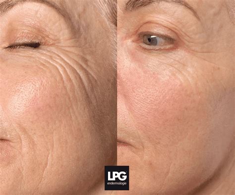 Detailná fotografia tváre s viditeľnými zlepšeniami po ošetrení LPG Face.