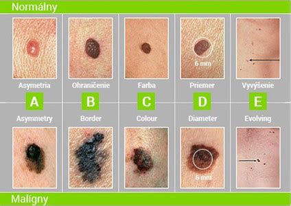 Schéma porovnávajúca vzhľad zdravého znamienka a podozrivého znamienka podľa pravidla ABCDE.