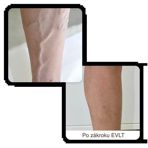 Koláž fotografií zobrazujúcich rôzne štádiá kŕčových žíl a prejavy venózneho ekzému na nohách.