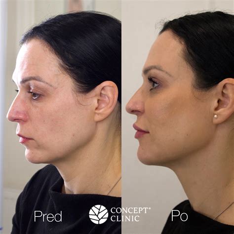 Obrázok znázorňujúci správnu vzdialenosť infralampy od tváre