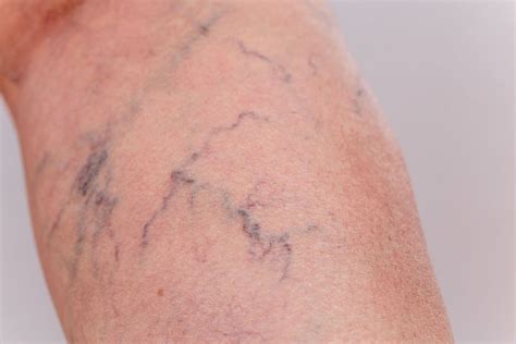 Infografika zobrazujúca princíp účinku heparínu a heparinoidov na kŕčové žily