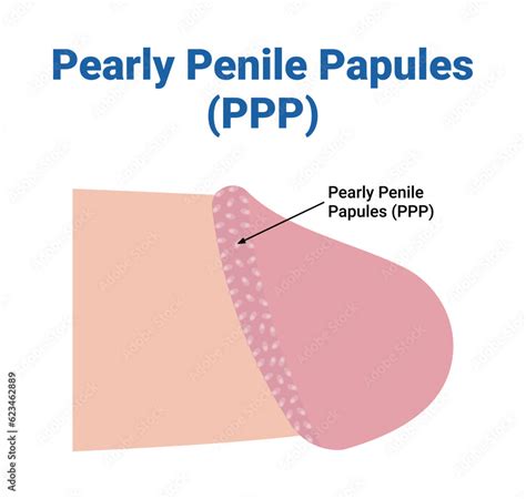 Zväčšený pohľad na perlové penilné papuly na korune žaluďa.