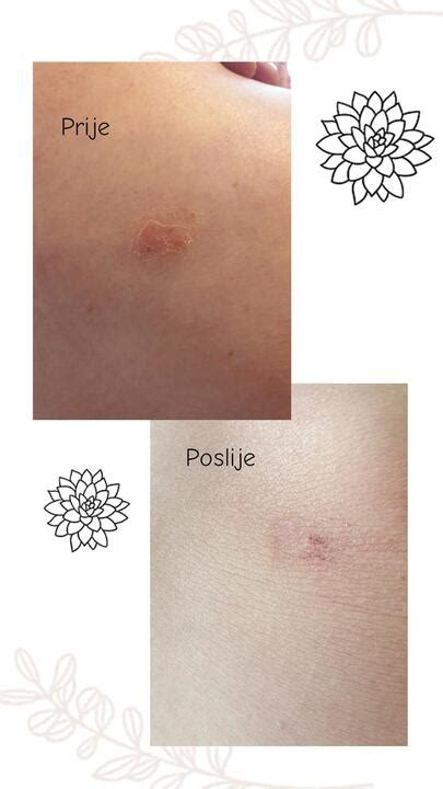 zobrazenie pustúl na koži pri pustulárnej psoriáze