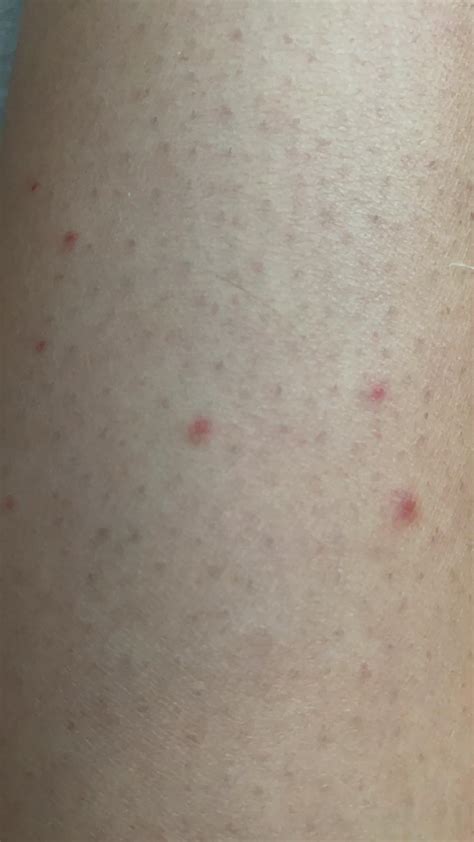 Ilustrácia pokožky na rukách a nohách