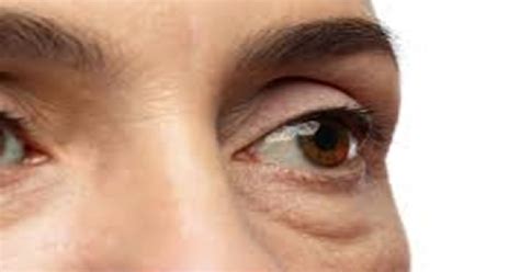 Ilustračná fotografia zobrazujúca opuchnuté oči