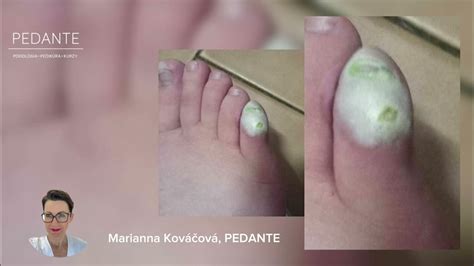 Ilustrácia tmavého pruhu na nechte ako možného príznaku subunguálneho melanómu.