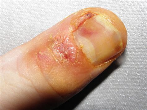 Obrázok 1: Zväčšený pohľad na nechtové lôžko s tumorom.