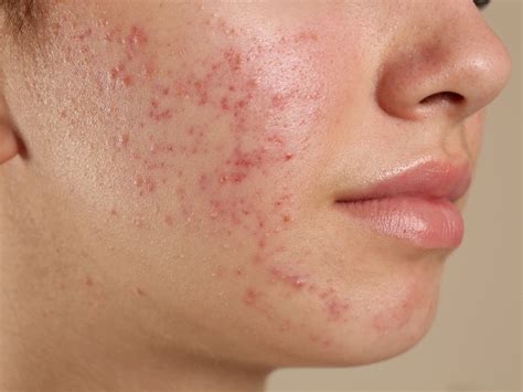 Fotografia ženy s miernym akné na tvári, s dôrazom na zdravú pleť.