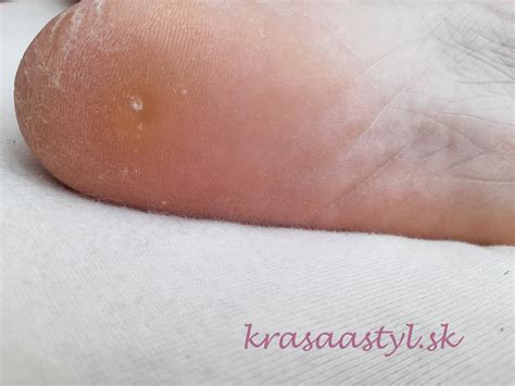 Ilustrácia znázorňujúca rozdiel medzi bradavicou a znamienkom, s detailným pohľadom na povrch a štruktúru oboch.