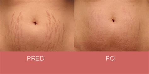 Ilustračná fotografia ženy nanášajúcej spevňujúci krém na brucho