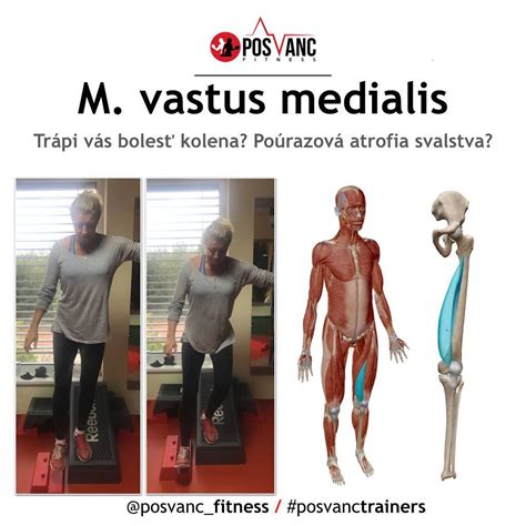 Schéma svalov prednej a bočnej strany krku, s vyznačenou platysmou a sternocleidomastoidom.