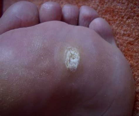 detailný záber plantárnej bradavice na chodidle s viditeľnými čiernymi bodkami