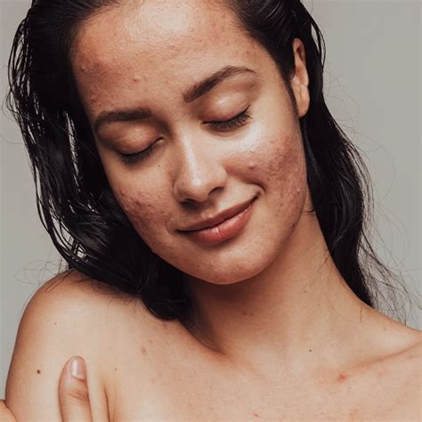 Ilustračná fotografia tváre so sklonom k akné