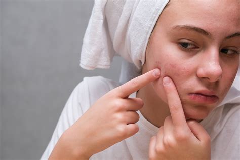 Detailná fotografia tváre s prejavmi akné a jazvami